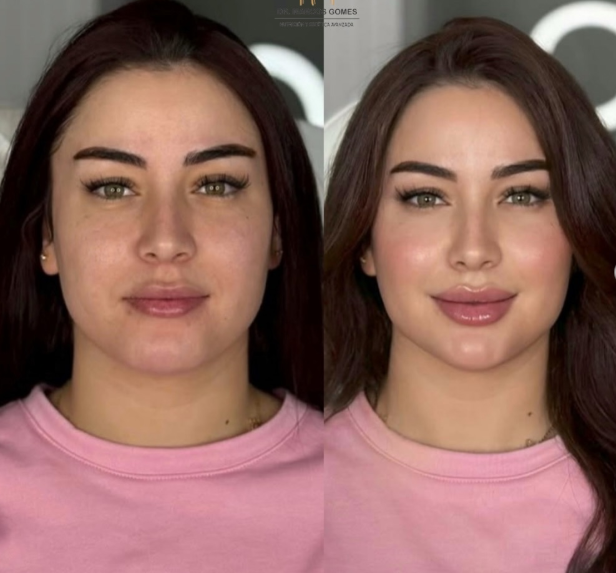 Facial harmonization to look younger, aesthetic treatments